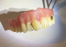 dentures